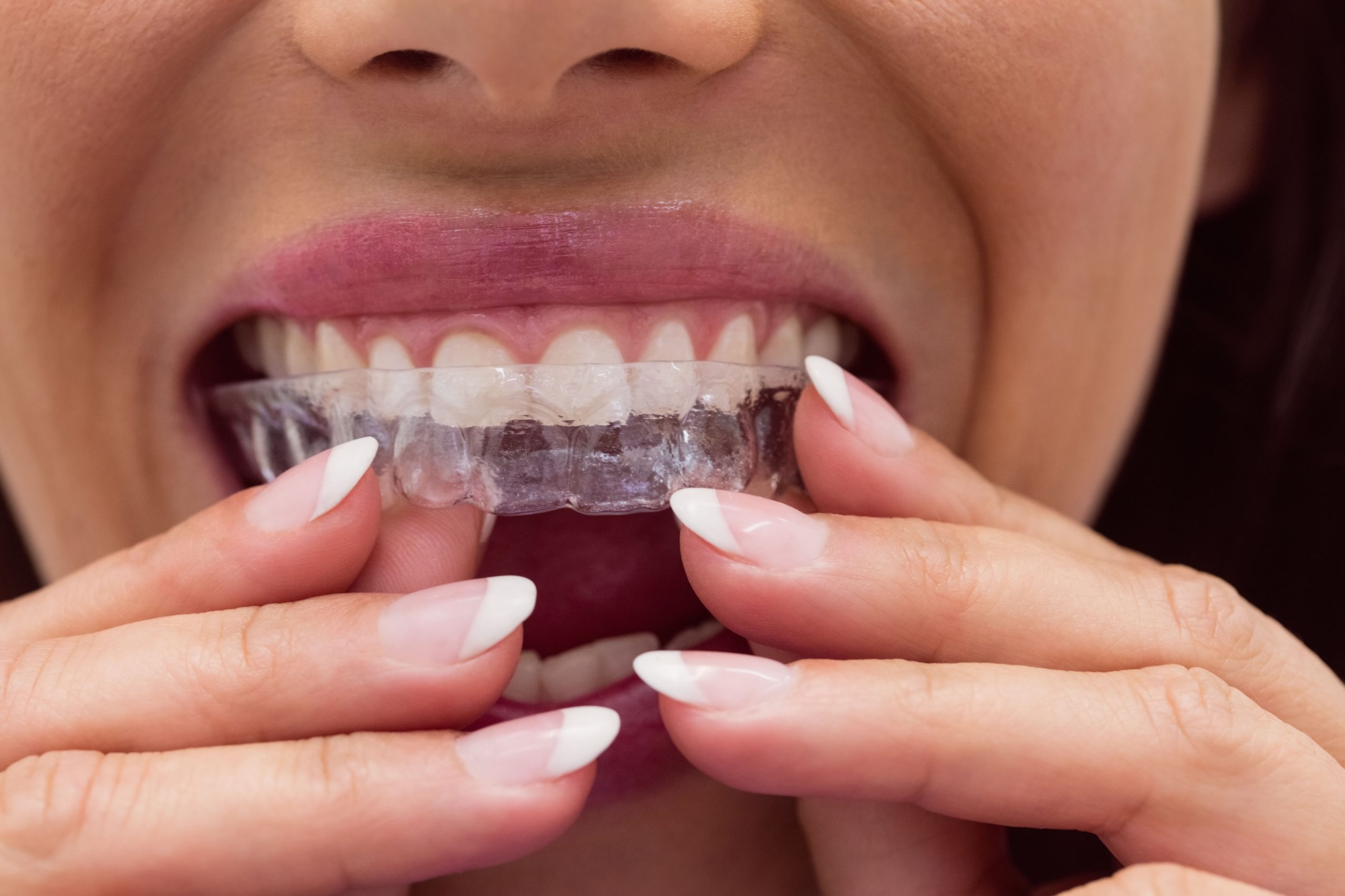 Night Guard for Teeth Grinding Ipswich: Dentist-Approved Tips